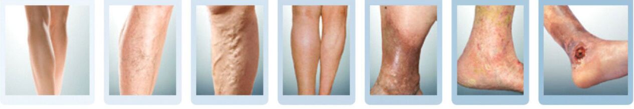 estágios de desenvolvimento das veias varicosas das pernas