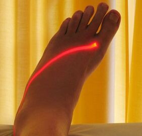 tratamento a laser de veias varicosas nas pernas
