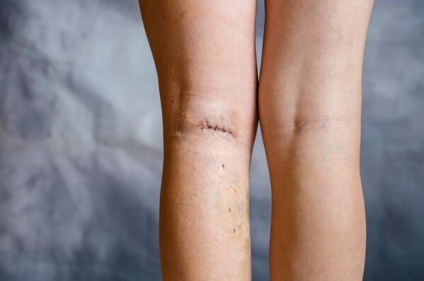 costura na perna após cirurgia para veias varicosas