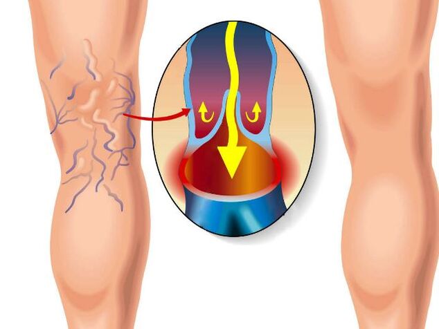 perna saudável e veias varicosas na perna