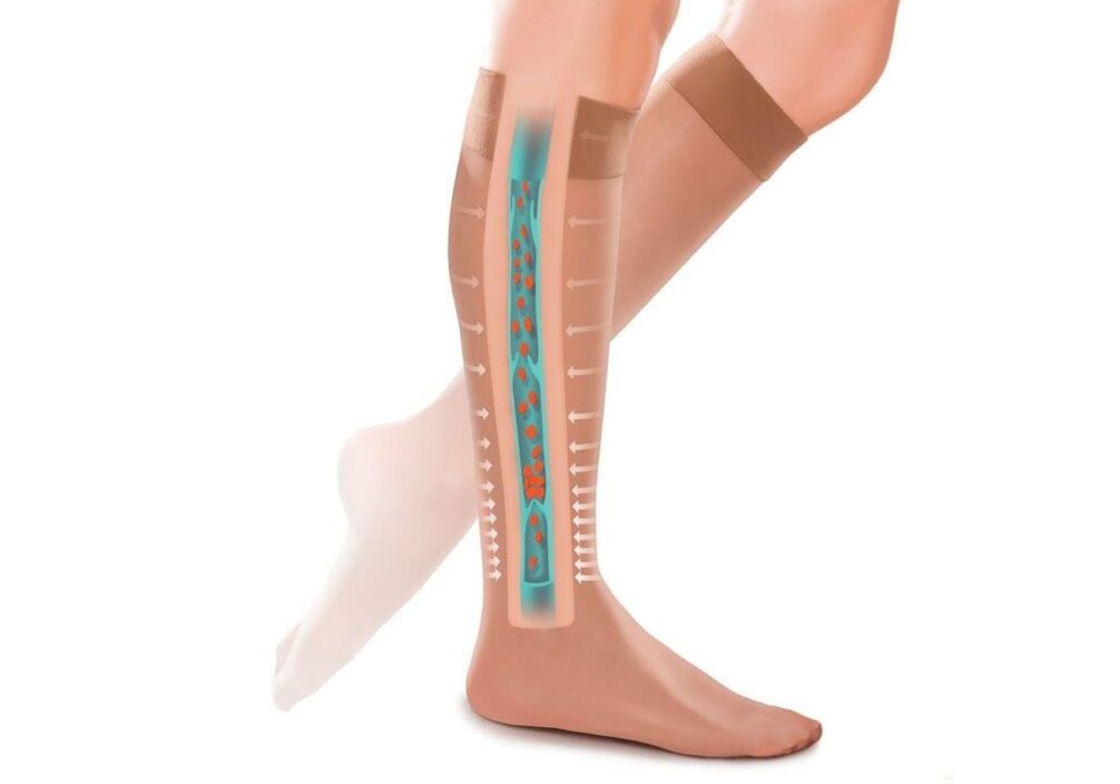 o efeito das meias de compressão nas pernas com veias varicosas