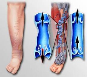 fluxo sanguíneo na perna com veias varicosas