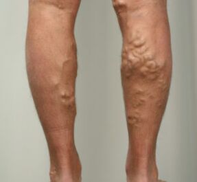 nódulos nas pernas com veias varicosas