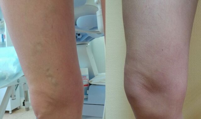 perna antes e depois do tratamento de varizes reticulares