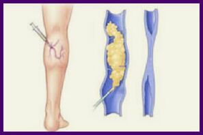A escleroterapia é um método popular para se livrar das veias varicosas nas pernas