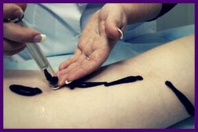 O procedimento para tratar varizes com sanguessugas (hirudoterapia)