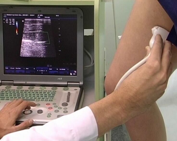 diagnóstico de ultrassom de varizes pélvicas