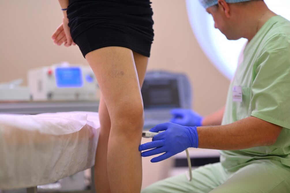 tratamento de varizes nas pernas