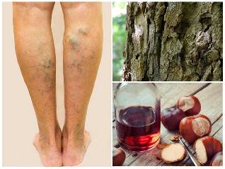 o tratamento as varizes de veias nas pernas folclóricas meios