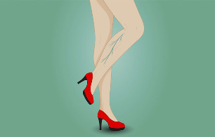 Varizes nas pernas de uma mulher