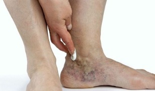 manifestações de veias varicosas nas pernas