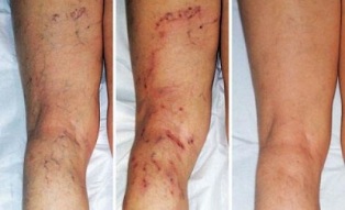 sintomas de veias varicosas nas pernas