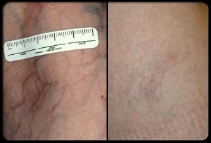 Antes e depois do procedimento de terapia a laser