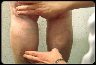 Médico examina pernas com veias varicosas