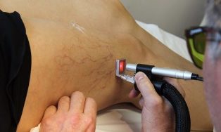 o tratamento a laser as varizes