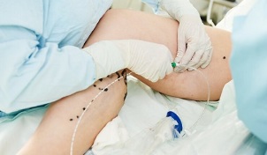 métodos de tratamento de varizes nas pernas em mulheres