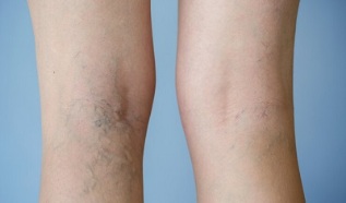 sinais de veias varicosas nas pernas em mulheres